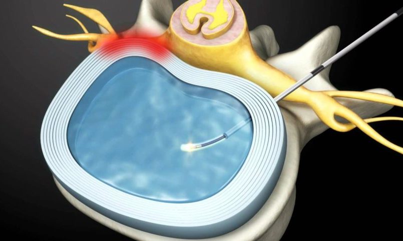 bel fıtığı nükleoplasti