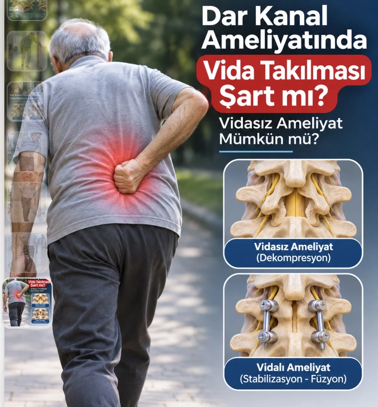 Dar Kanal Ameliyatında Vida Takılması Şart mı? Vidasız Ameliyat Mümkün mü?